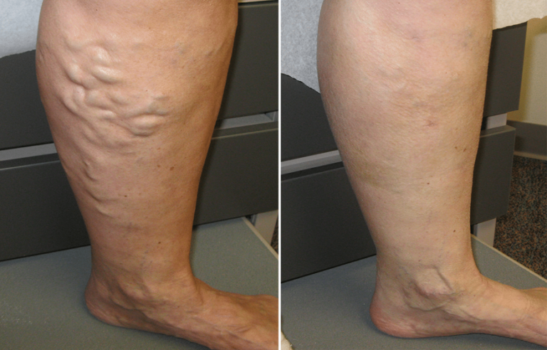 Varicose Veins General Treatments Available Today